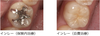インレー修復