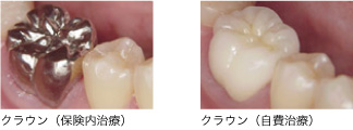 クラウン修復