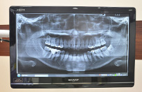 レントゲン写真