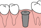 インプラント2