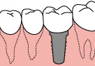 インプラント3
