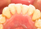 歯周病治療後